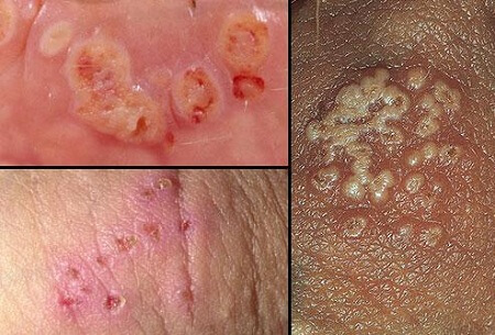 Ảnh bệnh Lậu ở nam và nữ giới