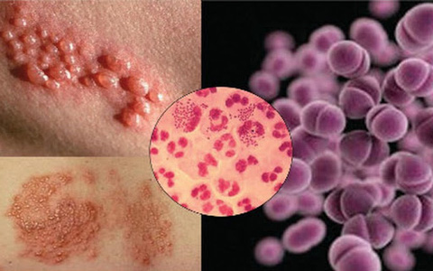 Virus Lậu
